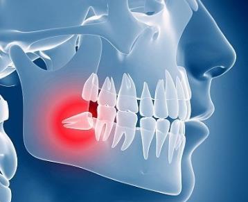 智齿牙龈肿痛怎么办？