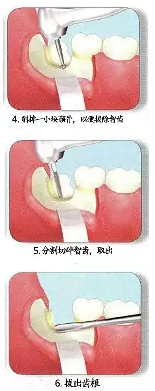 智齿的拔除过程有哪些