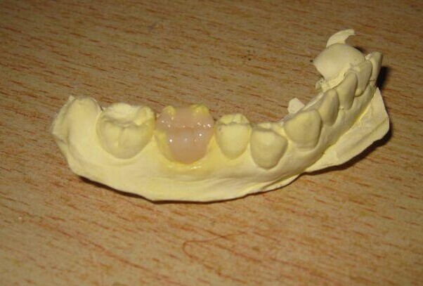 儿童龋齿补牙过程是怎样的？