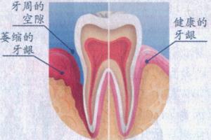 牙龈萎缩可以装假牙吗