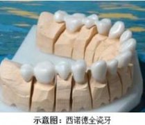 深圳做西诺德全瓷牙需要多少钱？
