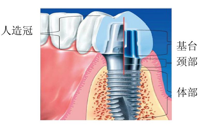 种植牙 种植义齿    种植义齿是一种有效的牙齿缺失修复方式,而且美观