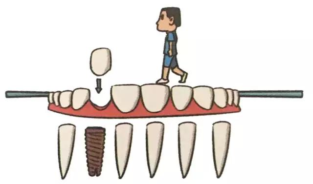 种植牙各种品牌之间有什么区别？