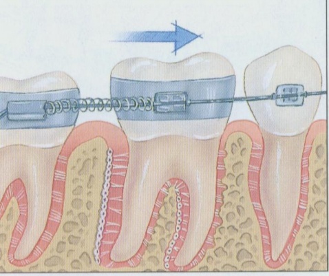 为什么牙齿矫正结果不明显？