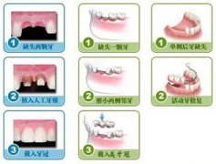 镶牙的过程是怎样的,镶牙的过程