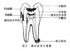 对于虫牙和牙齿缺损，有哪些常见