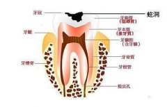 治疗牙髓炎的方法有哪些