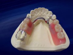 可摘局部义齿有哪些种类？