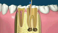 什么样的蛀牙需要做根管治疗？
