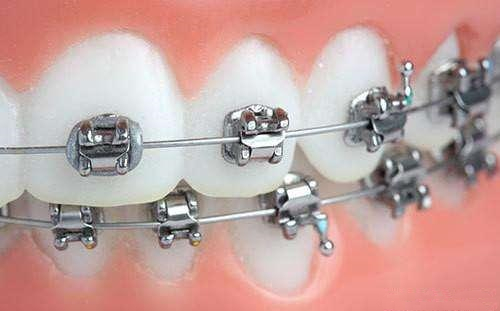 为什么一根钢丝就能矫正牙齿？