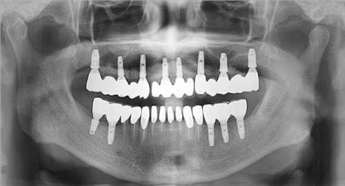 种植牙过程到底是怎样的?