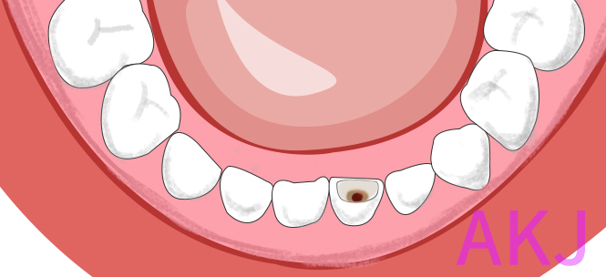蛀牙洞
