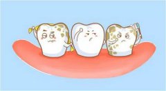 为什么会有氟斑牙？如何治