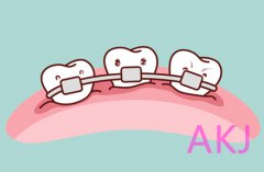 爱康健矫牙：正畸戴牙套疼痛，是因为加力过大吗？