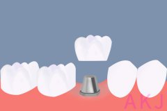 爱康健缺牙修复|大牙掉了如何修复？